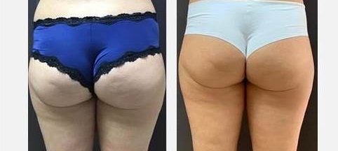 OndaDinamica fesse - Institut by Scarlett