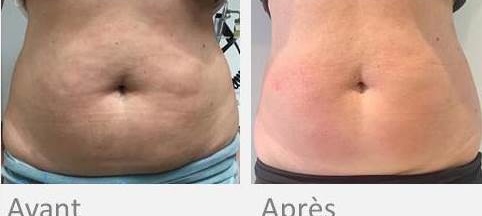 OndaDinamica ventre - Institut by Scarlett