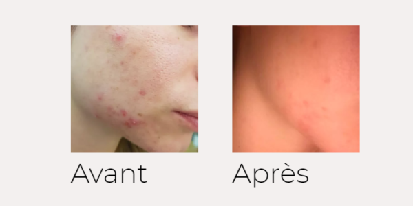 X-SKIN AGE traitement visage avant-après Ondadinamica Selènia Italia