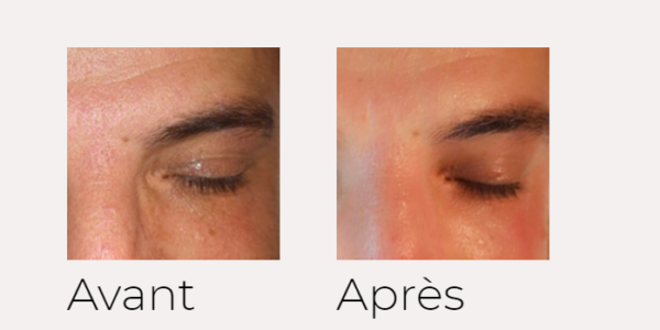 X-SKIN AGE traitement visage avant-après Ondadinamica Selènia Italia