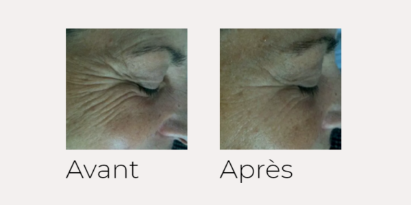 X-SKIN AGE traitement visage avant-après Ondadinamica Selènia Italia