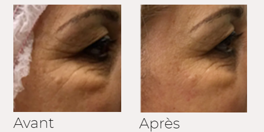 X-lift traitement visage avant-après Ondadinamica Selènia Italia