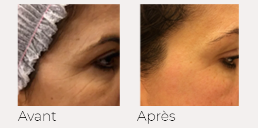 X-lift traitement visage avant-après Ondadinamica Selènia Italia