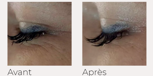 X-lift traitement visage avant-après Ondadinamica Selènia Italia