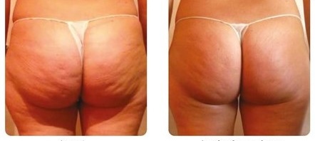 x-magic avant-après fesse traitement corps ondadinamica Institut by Scarlett