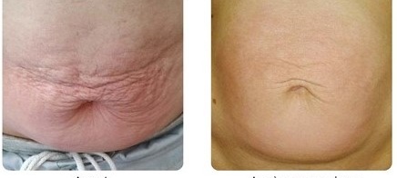 x-magic avant-après ventre traitement corps ondadinamica Institut by Scarlett