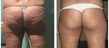 x-magic avant-après fesse traitement corps ondadinamica Institut by Scarlett
