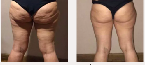 X-magic avant-après fesses jambes traitement corps Ondadinamica Selènia Italia