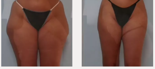 X-magic avant-après traitement corps Ondadinamica Selènia Italia