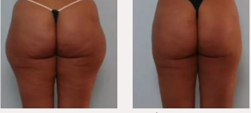 X-magic avant-après fesses traitement corps Ondadinamica Selènia Italia